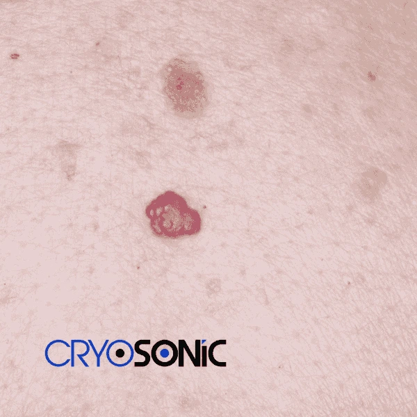 Looking for pain free cherry angioma removal treatment Wembley? Call our team today! Wembley