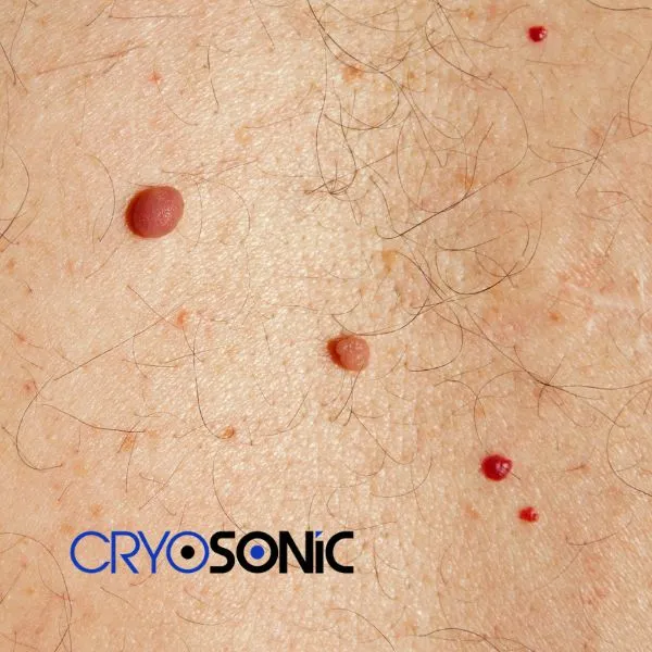 get cherry angioma removal treatment today! Wembley