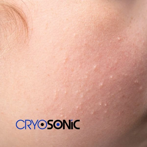 Are you looking for milia removal treatment? Contact our team today Wembley