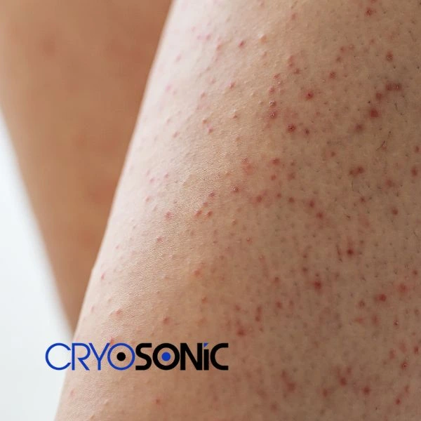 Looking for Seborrhoeic Keratosis removal Wembley treatment? Call our consultants today in Wembley