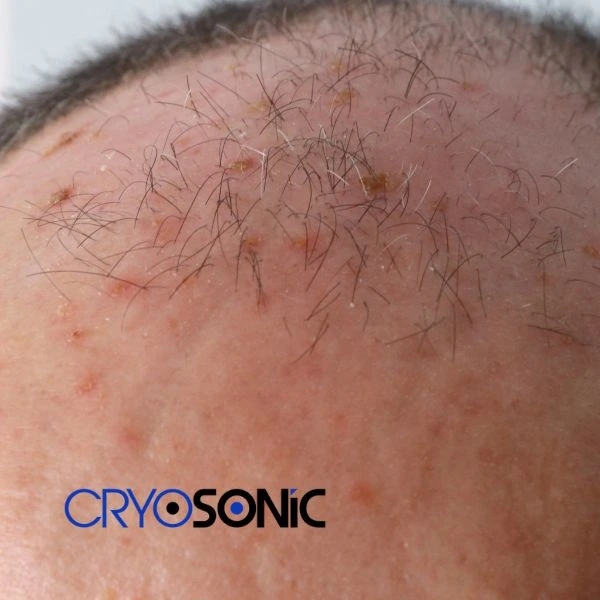 Access Seborrhoeic Keratosis removal from the comfort of your own home! Call us today in Wembley