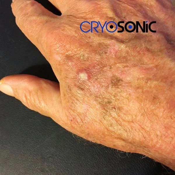Understand more about actinic keratosis treatment today Wembley