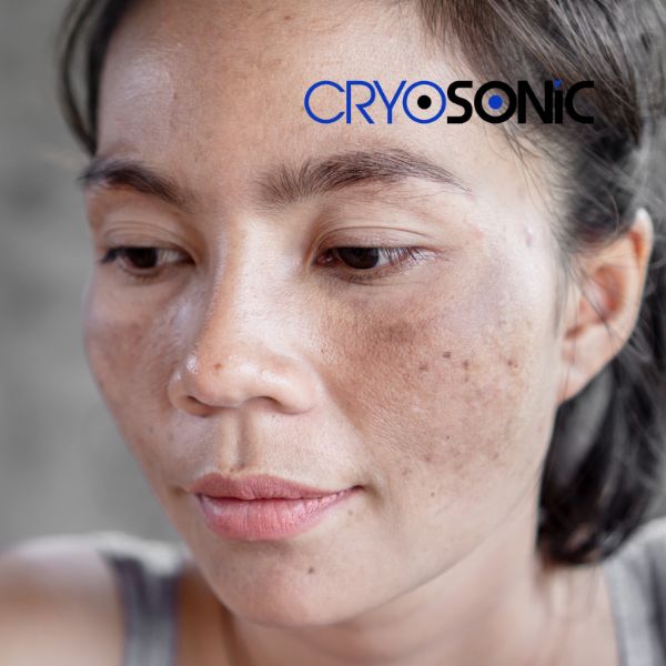 Ready to start age spots removal? Contact our team today in Wembley