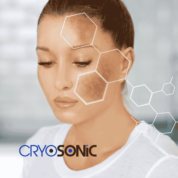 Are you looking for age spot removal treatment? Contact Cryosonic today in Wembley
