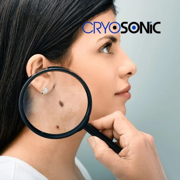 Do you want to learn more about benign moles removal treatment? Call our team today Wembley