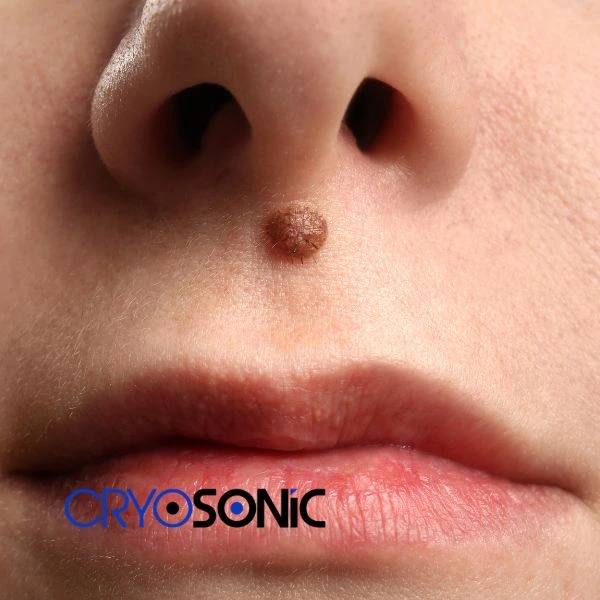 Start your benign moles removal treatment today Wembley