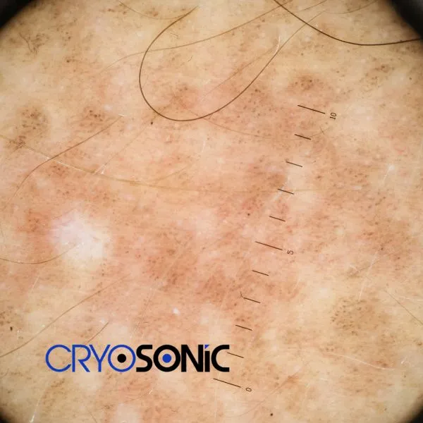 Speak to our team today about sun damaged skin treatment today in Wembley