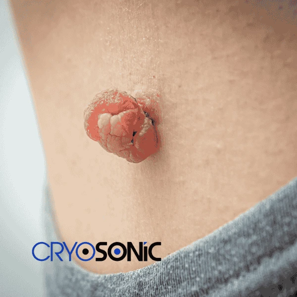 Book your skin tags removal Wembley from comfort of your own home! Wembley