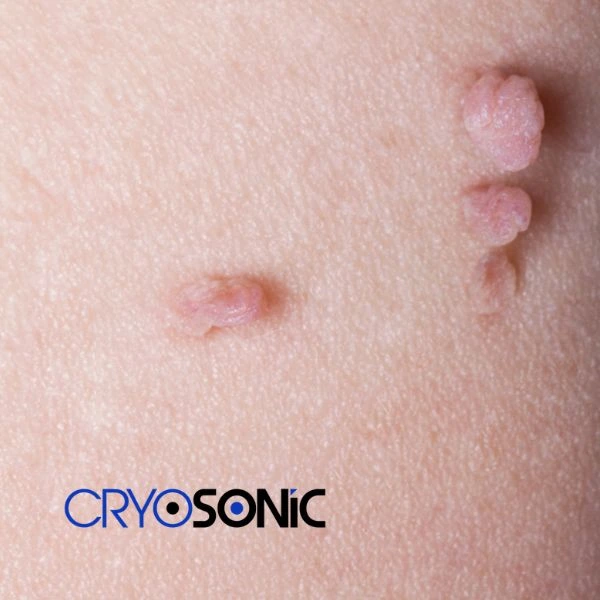 Are you looking for fast effect skin tag removal Wembley? Book in NOW! Wembley