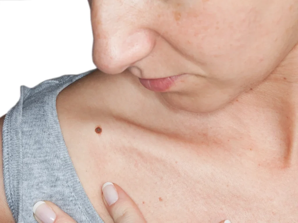 How Does CryoPen Sun Damage Treatment Wembley Work? Wembley