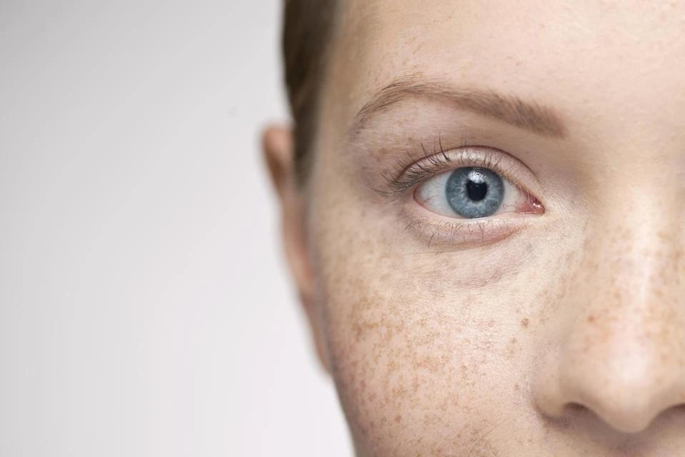 Understanding Sun Damage: How UV Rays Alter Skin and How CryoPen Can Reverse It Wembley