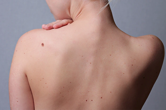 The Skin&rsquo;s Healing Journey After CryoPen Sun Damage Treatment Wembley