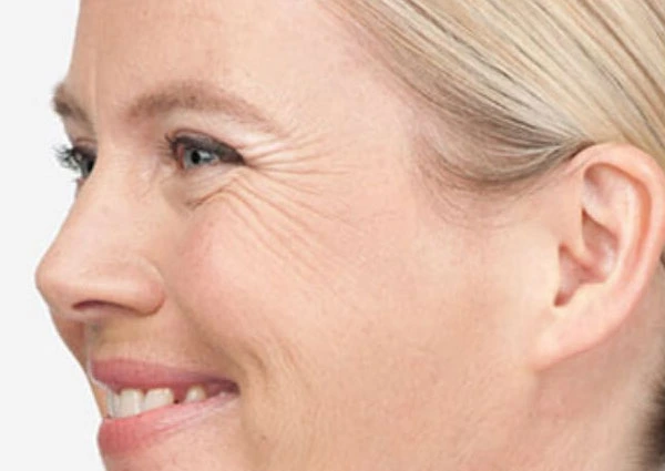 CryoPen Precision vs. Laser: Which Is Better for Sun-Damaged Skin? Wembley