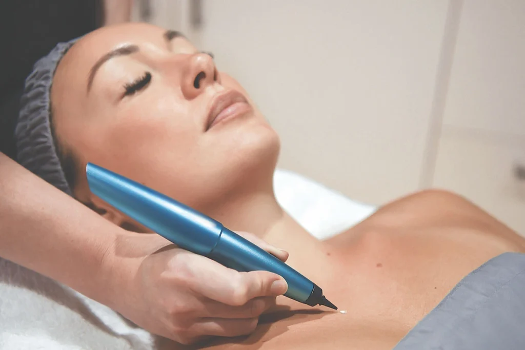 What is CryoPen Technology Wembley? Wembley