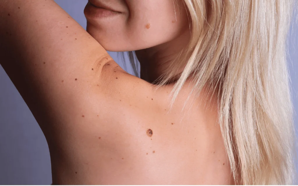 What Are Sun Spots and Pigmentation Wembley? Wembley