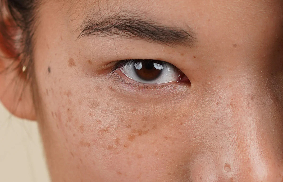Is There Any Risk of Scarring or Pigmentation Wembley? Wembley