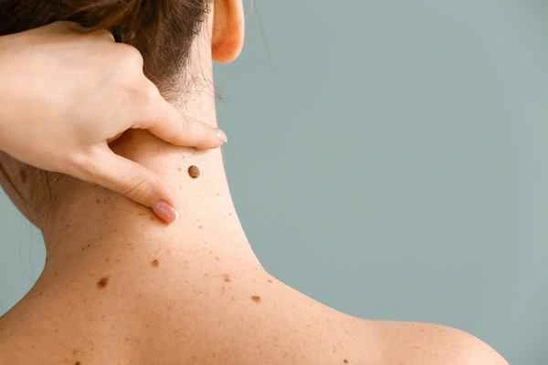 Who Should Avoid CryoPen Treatments? Wembley