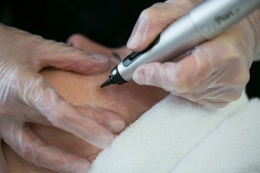 The CryoPen Technology Explained: How Extreme Cold Removes Sun-Damaged Skin Cells Wembley