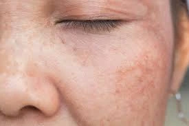 CryoPen Precision vs. Laser: Are Both Treatments Safe? Wembley
