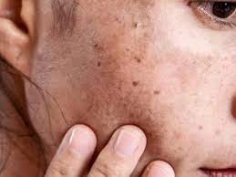 Why CryoPen Works Best for Isolated Sun Spots and Pigmentation Wembley