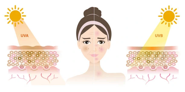 Understanding Sun Damage Wembley : How Do UV Rays Cause Changes in the Skin? Wembley