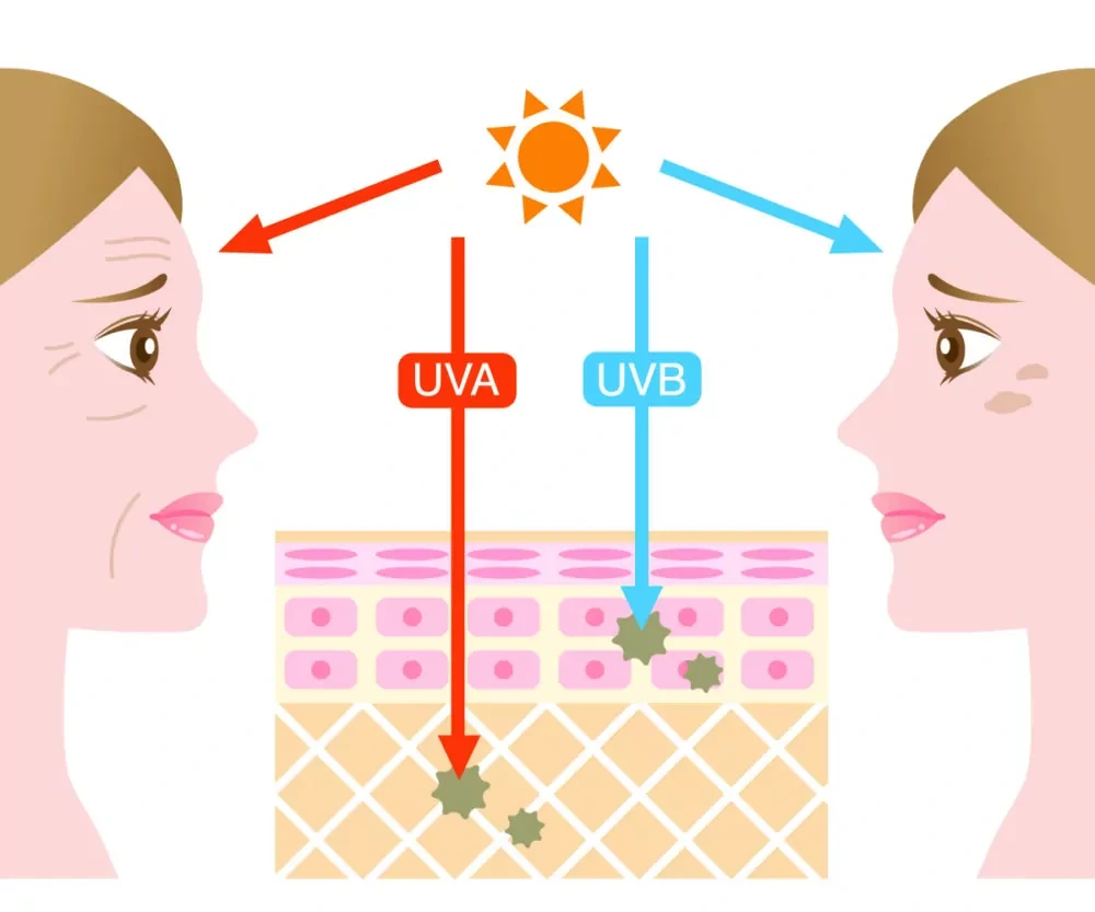 Understanding Sun Damage Wembley - Why Should Sun Damage Be Treated Early? Wembley